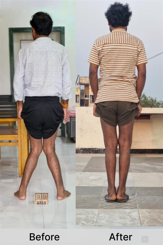 Knock Knee Surgery